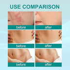 Medical Scar Removal Spray